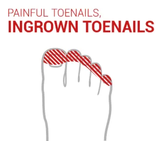 black and ingrown toenails