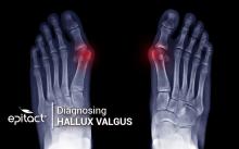 How to diagnose a bunion?