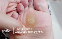 Plantar callus removal