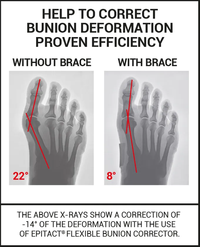 Flexible bunion corrector epitact