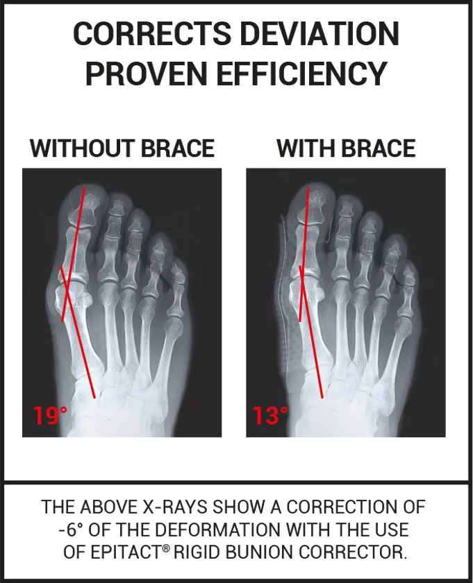 Rigid bunion corrector epitact