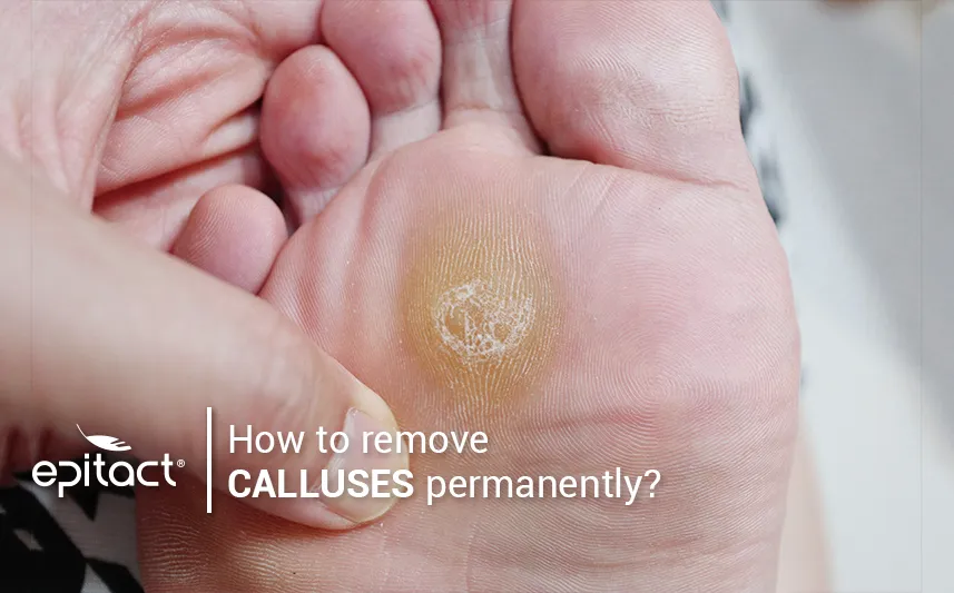 Plantar callus removal: how to get rid of calluses on feet
