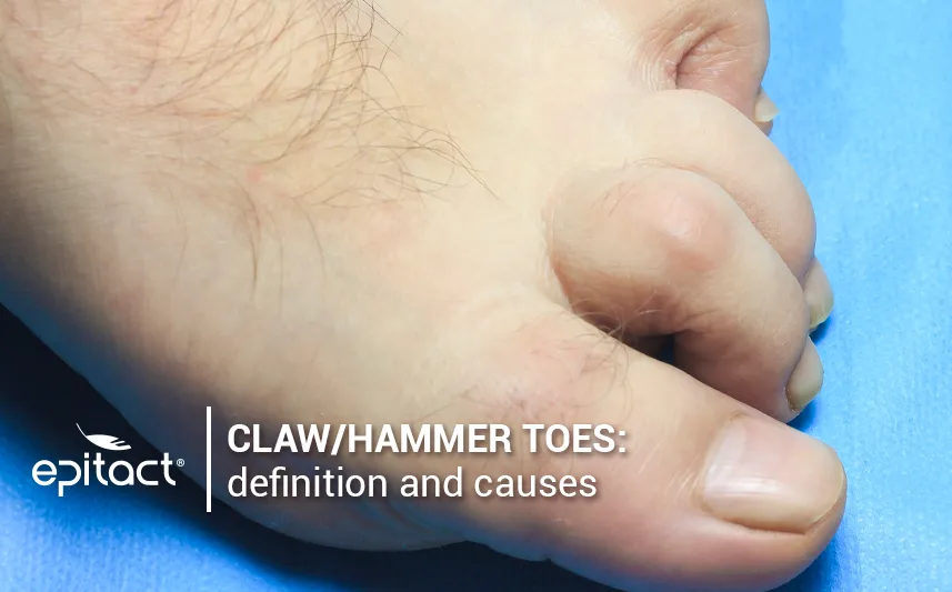 What is a hammer toe?