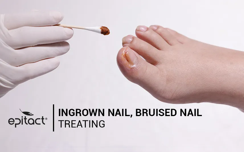 Bruised toenail treatment